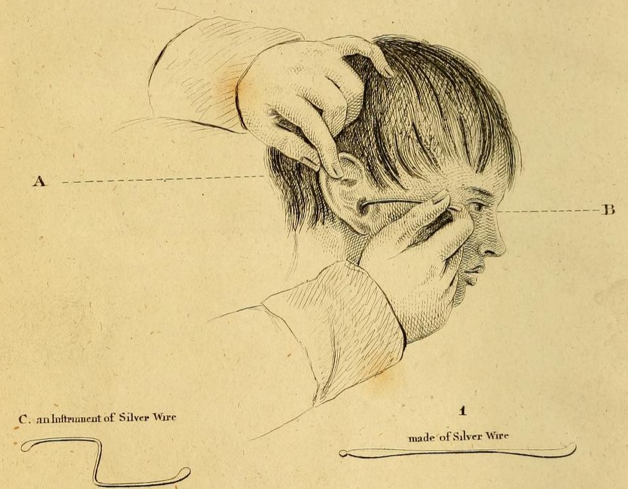 Diagram of doctor inspecting a child's ear.